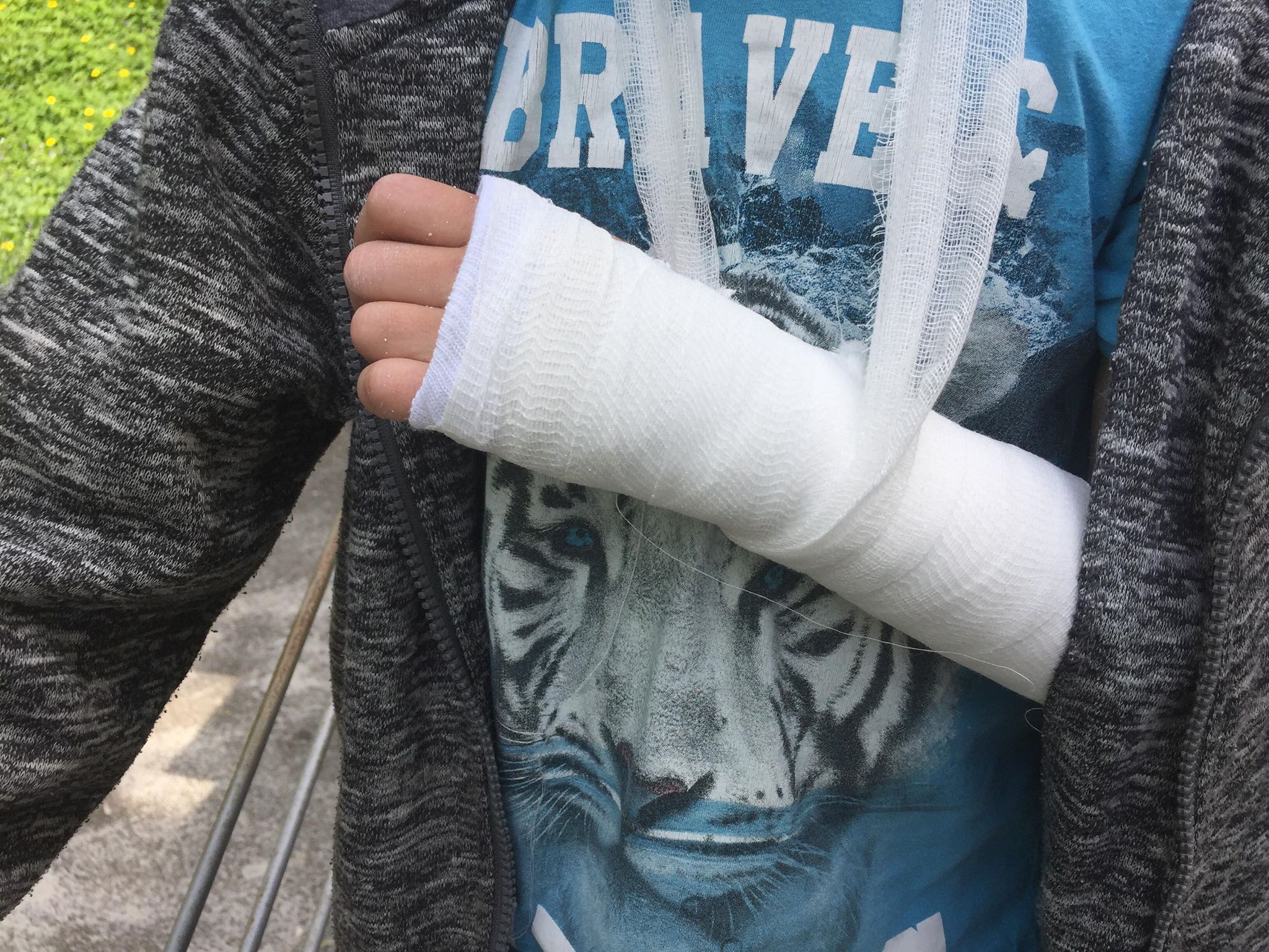 Суд звільнив від відповідальності неповнолітнього, з вини якого школяр зламав руку