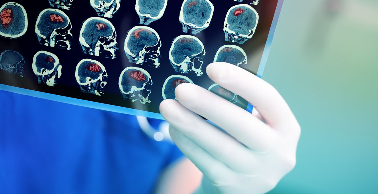 На Кіровоградщині 6 лікарень безоплатно лікують інсульт