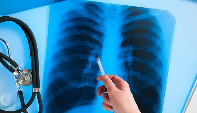 Лікарні Кіровоградщини отримають ліки для лікування туберкульозу